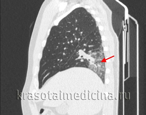 КТ органов грудной клетки. Участок воспалительной инфильтрации (пневмония) в задних каудальных отделах нижней доли правого легкого