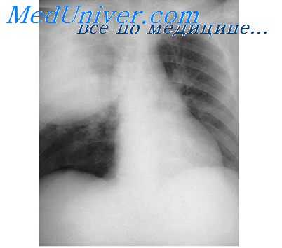 бронховаскулярный барьер легких