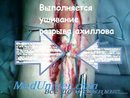 операция при разрыве ахиллова сухожилия