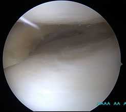 парциальная-резекция-мениска-