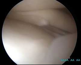 разрыв-мениска-ручка-лейки