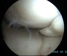 разрыв-мениска-два-лоскута
