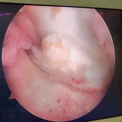 разрыв мениска фото