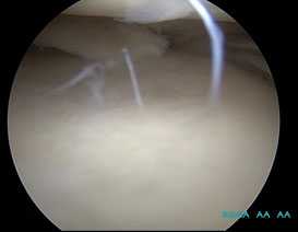 комбинированный-разрыв-мениска