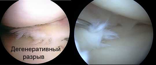 дегенеративный-разрыв