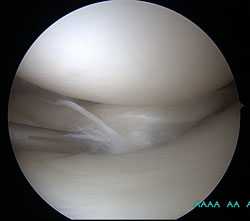 разрыв-медиального-мениска