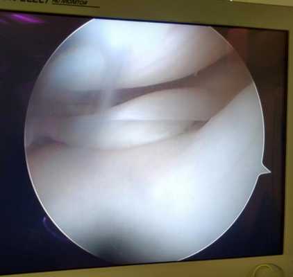 разрыв наружного мениска коленного сустава