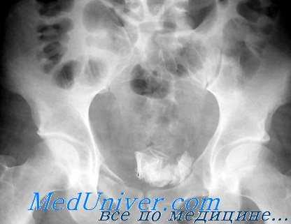 травма мочевого пузыря