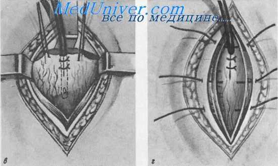 Надлобковый свищ мочевого пузыря (цистостомня)