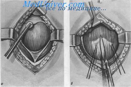Надлобковый свищ мочевого пузыря (цистостомня)