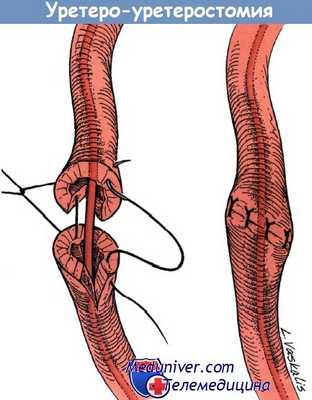 Уретеро-уретеростомия