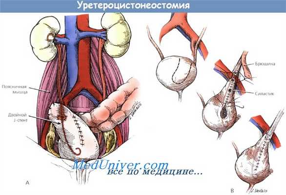 Уретероцистонеостомия