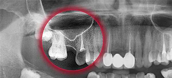 перфорация гайморовой пазухи