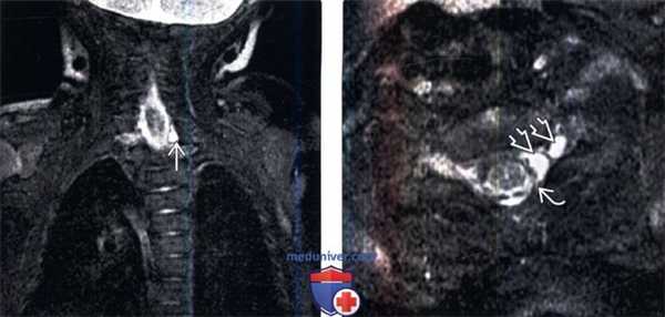 МРТ при тракционном повреждении плечевого сплетения