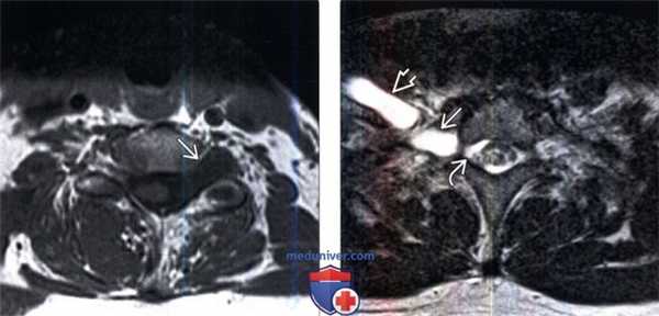 МРТ при тракционном повреждении плечевого сплетения