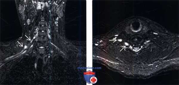 МРТ при тракционном повреждении плечевого сплетения
