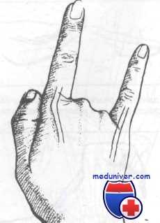 повреждения сухожилий кисти