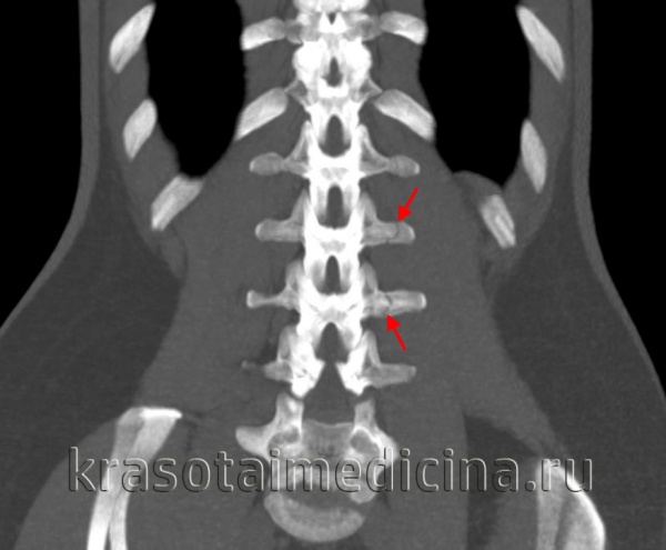 Травма позвоночника