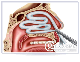Передняя тампонада носа