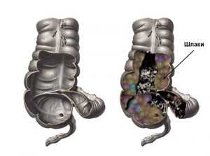 Шлаки в кишечнике