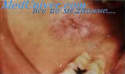 волчанка слизистой рта