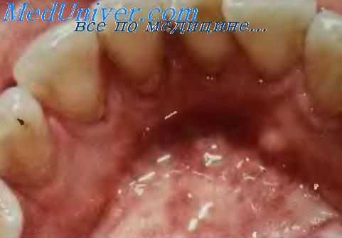 Позадиклыковой сосочек