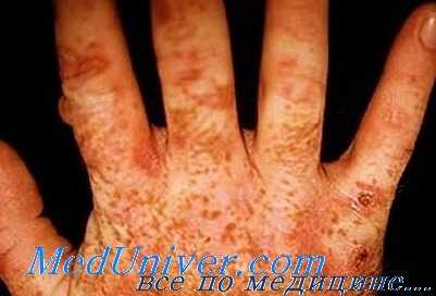 поздняя кожная порфирия