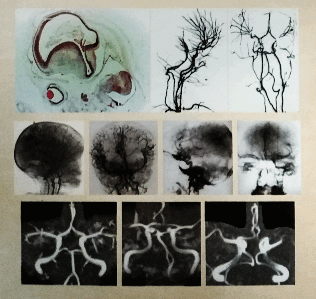 Классификация вариантов артерий и вариантов артериального круга большого мозга человека