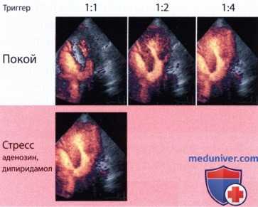 Практическое применение контрастной эхокардиографии миокарда
