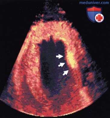 Перспективы применения контрастной эхокардиографии