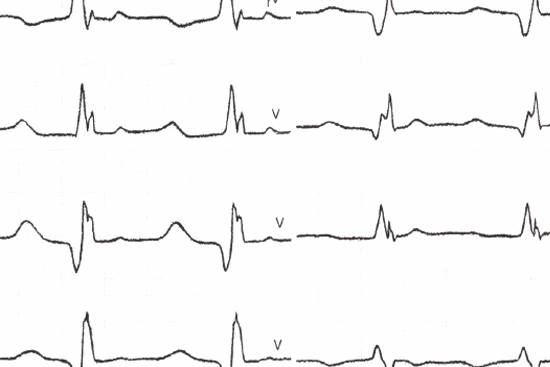 Блокада Гиса