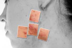 Появление прыщей во время ПМС