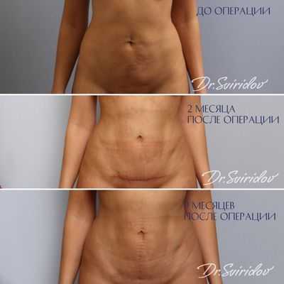 Мини — абдоминопластика, что это такое⁉️