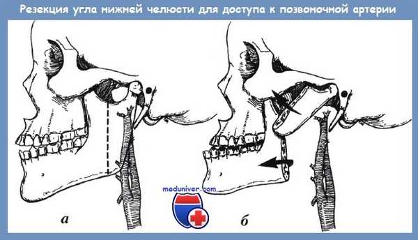 резекция нижней челюсти для доступа к позвоночной артерии