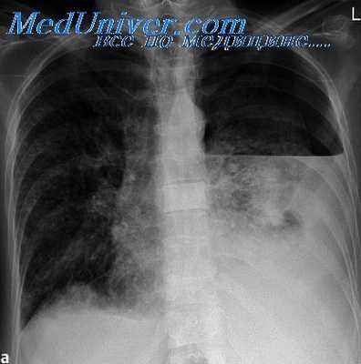 туберкулез легких