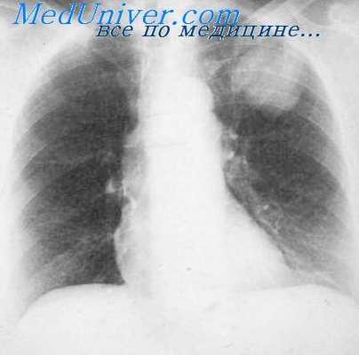 резекция легких