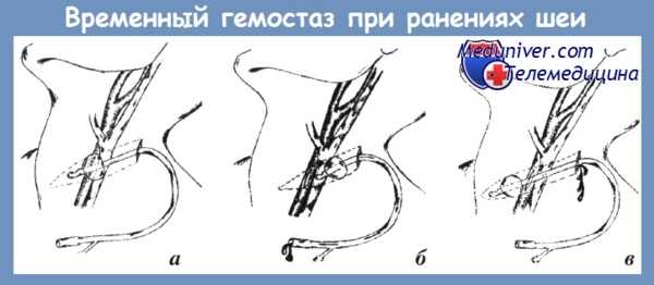 временный гемостаз при ранениях шеи