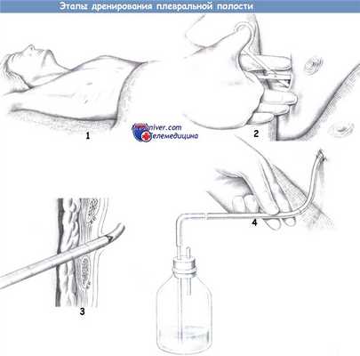 Этапы дренирования плевральной полости