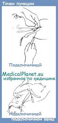 точки пункции подключичной вены