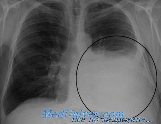Рентгенограмма при гемотораксе