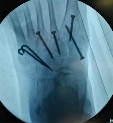 вывих в суставе лисфранка операция