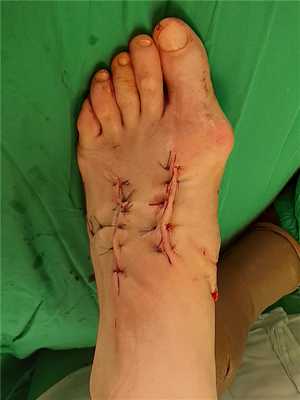 вывих в суставе лисфранка реабилитация