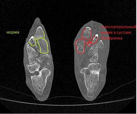вывих в суставе Лисфранка КТ
