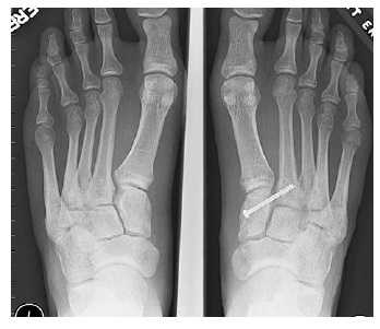 как лечить вывих стопы