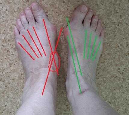 вывих в суставе лисфранка клинический случай