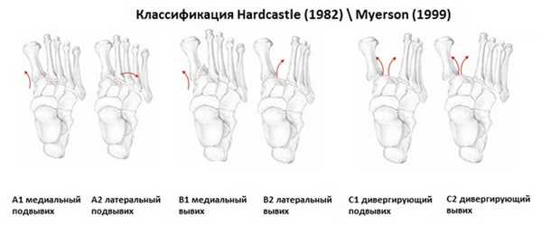 вывих в суставе лисфранка классификация
