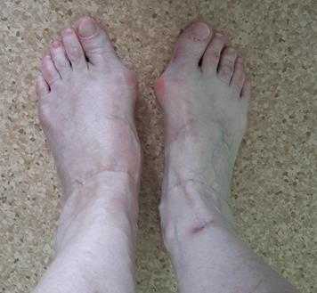 вывих в суставе лисфранка фото