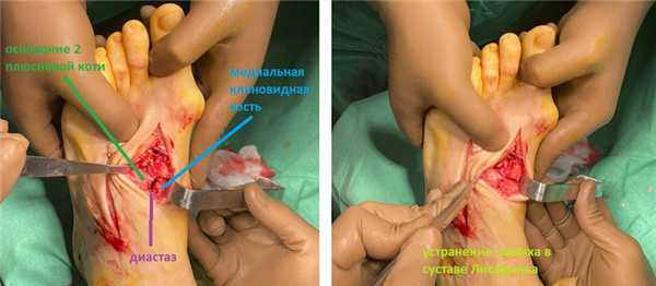 вывих в суставе лисфранка лечение