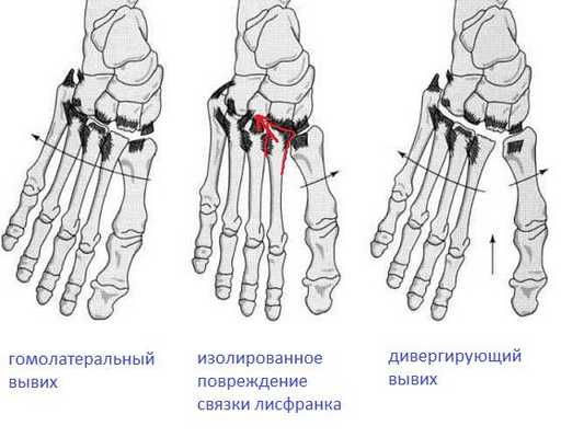 классификация вывихов в суставе Лисфранка