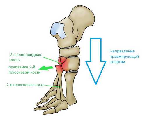 механизм вывиха в суставе лисфранка